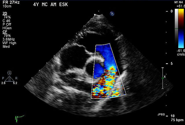 Ultrasound of heart