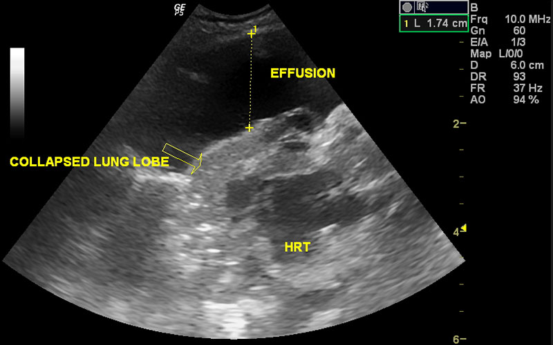 Ultrasound of collapsed lung lobe