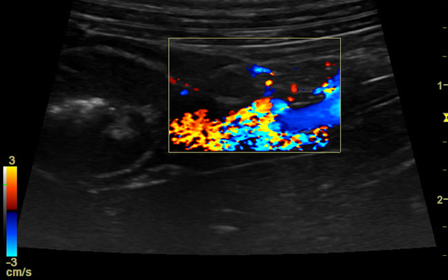 Ultrasound color map